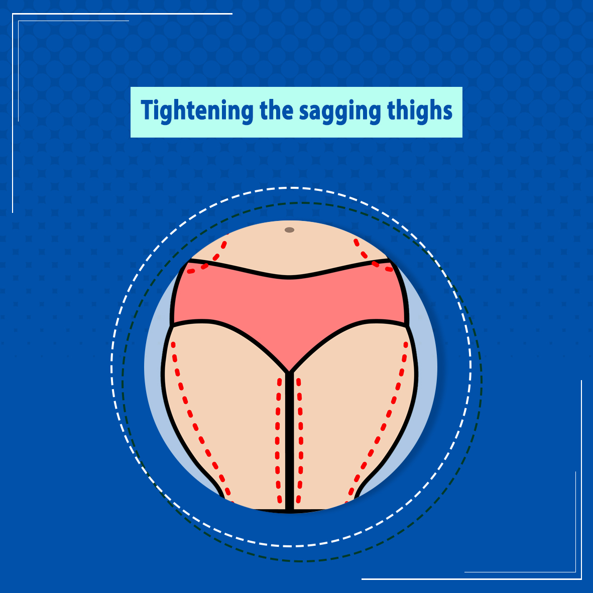 My experience with thigh lift