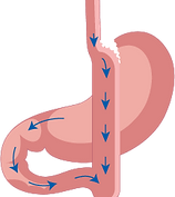  Gastric Bypass 