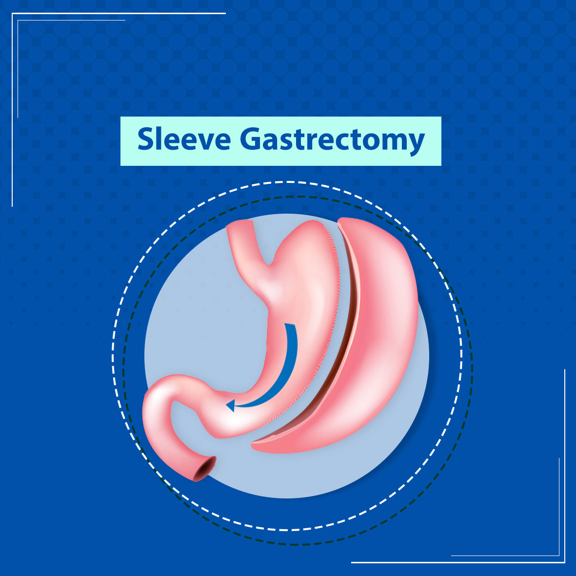 Sleeve Gastrectomy